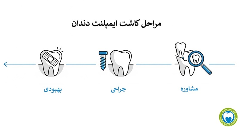 اینفوگرافیک مراحل کاشت ایمپلنت دندان