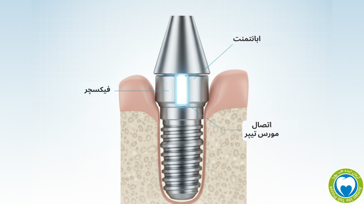 شماتیک اتصال مورس تیپر ایمپلنت دندان با مهر و موم بدون شکاف، تکنولوژی آرگون آلمان