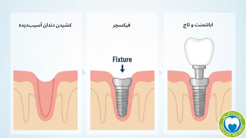 اینفوگرافیک مراحل کاشت ایمپلنت دندان با تأکید بر سلامت استخوان