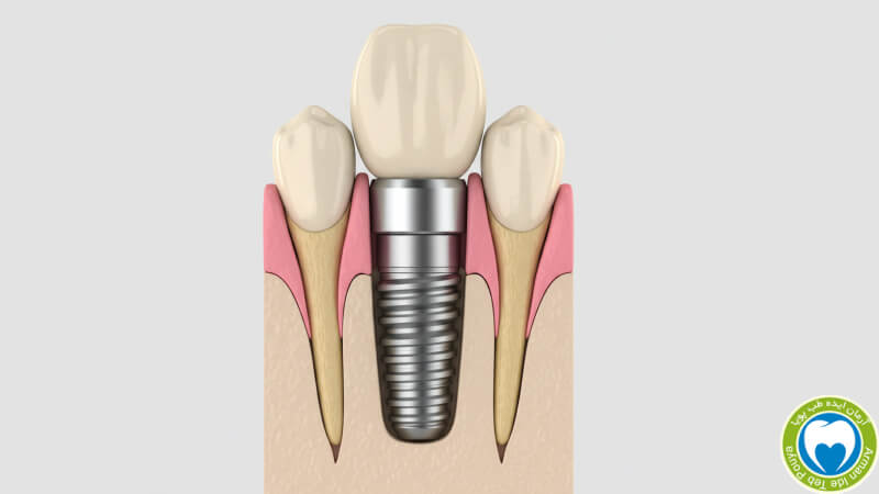 نمایش سلامت استخوان کرستال و لثه اطراف ایمپلنت مورس تیپر