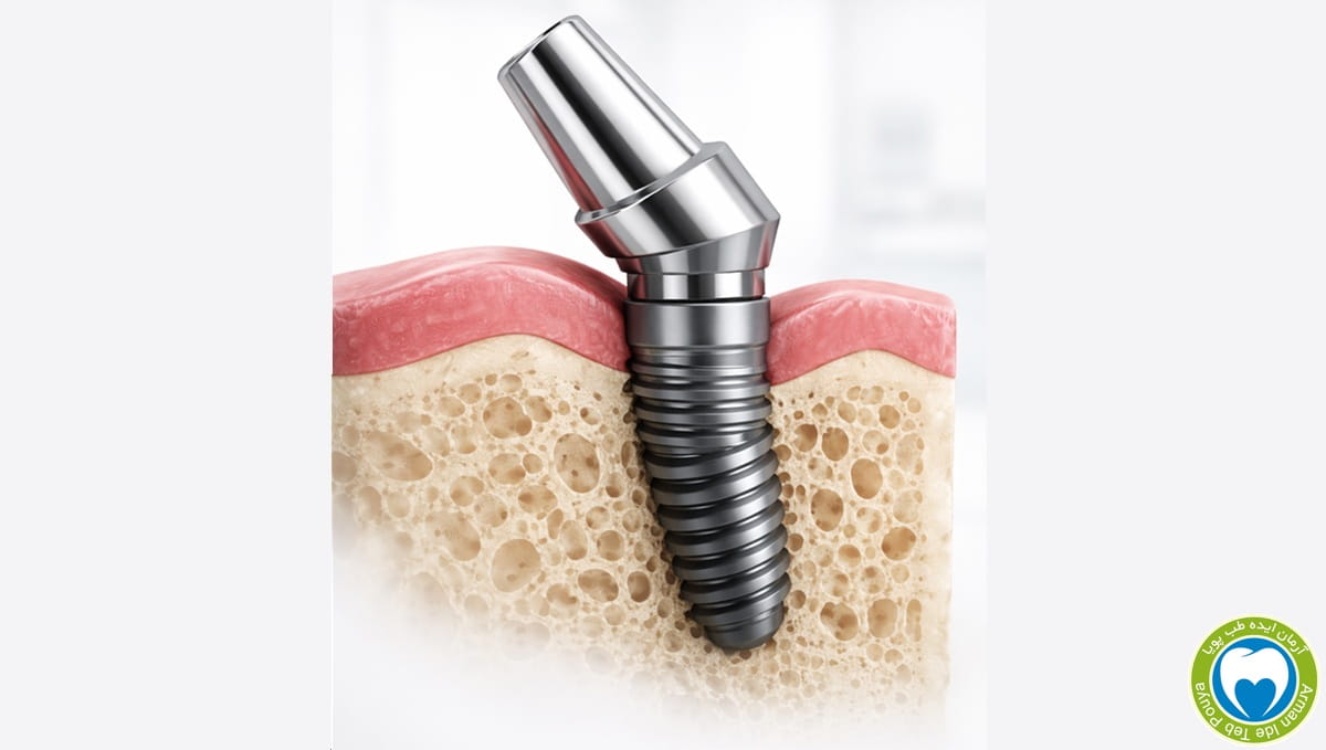 اباتمنت زاویه دار ایمپلنت RapidFix برای اصلاح زاویه در درمان All-on-4