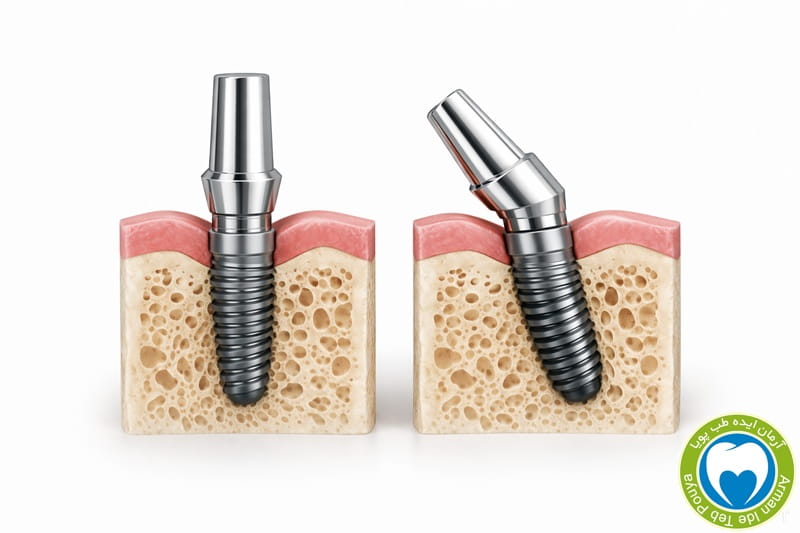 اصلاح زاویه ایمپلنت با اباتمنت زاویه دار