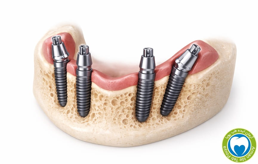 کاربرد اباتمنت زاویه دار در درمان All-on-4